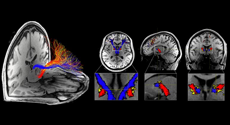 A Potential Neurological Cause of Heroin/Cocaine Addiction